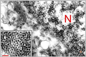 F,50y. | papilomavirus in glial cell - progressive multifocal leukodystrophy